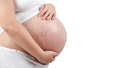 【医師監修】妊娠線ができるのはなぜ?産後は消える?予防方法や妊娠中の安全なケアのしかたも解説!
