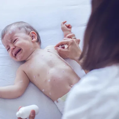 子どもの水ぼうそうのあとは残る?あとを残さないようにするために