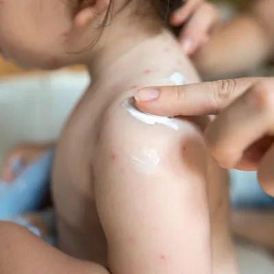 子どもの水ぼうそう(水疱瘡):症状や注意すること