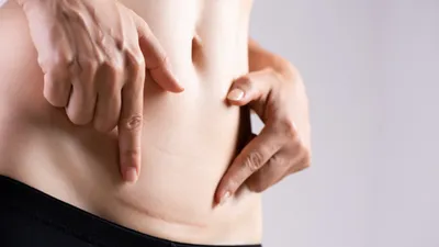 帝王切開の傷はいつ治る？傷跡を目立たなくするには？術後のケアや痛みを和らげる方法も解説