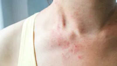 妊婦が風疹にかかるとどうなる?予防接種や抗体検査の必要性、赤ちゃんへの影響も解説