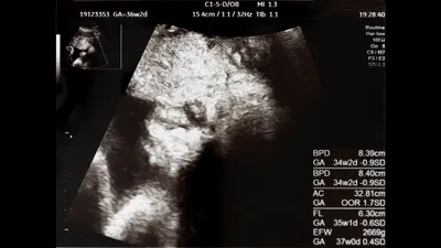 エコー写真の見方がわからない!専門用語の意味や時期ごとのチェックポイントを解説!