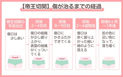 帝王切開の傷はいつ治る？傷跡を目立たなくするには？術後のケアや痛みを和らげる方法も解説