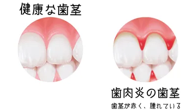 なぜ子どもでも歯周病になるの?原因と家庭でのケア方法