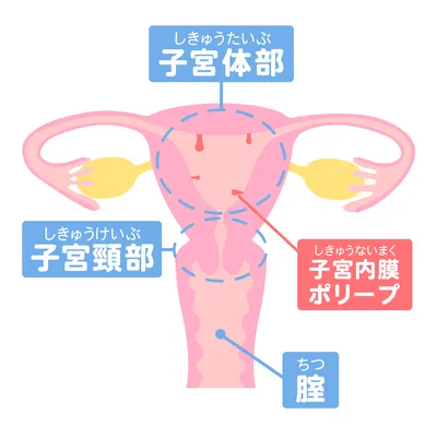 子宮内膜ポリープの説明